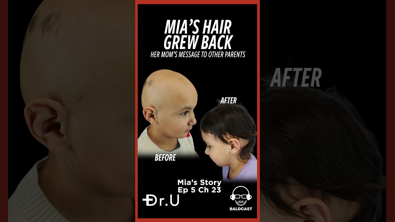 Don’t Give Up: A Parent’s Message on Pediatric Alopecia Areata