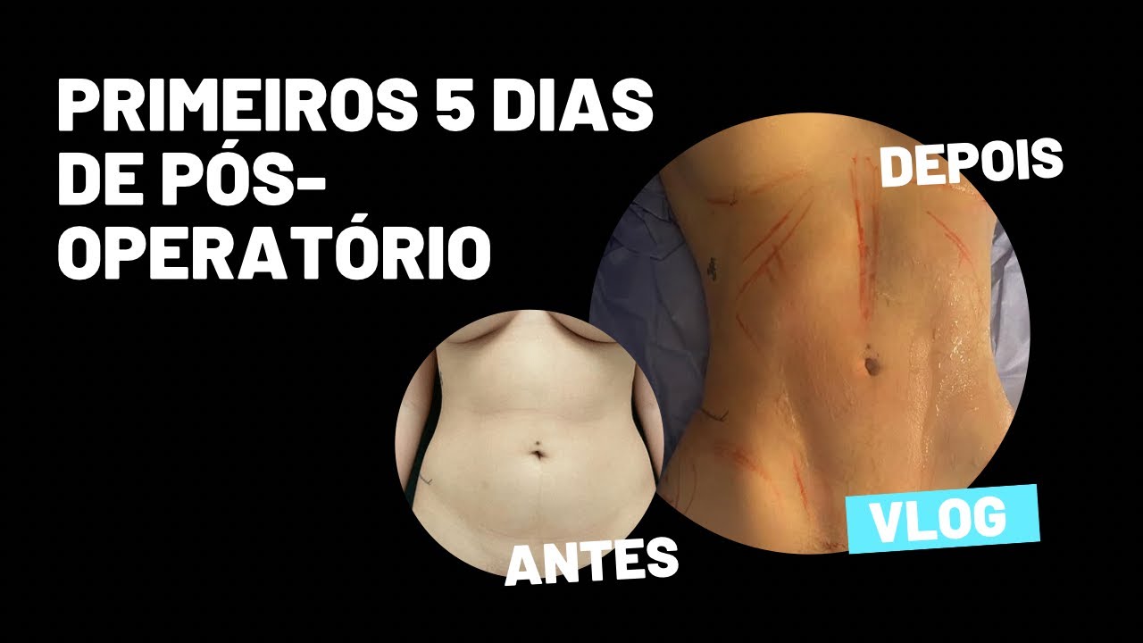 VLOG: Primeiros 5 Dias de Pós-operatório da Lipoescultura | Antes e ...