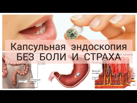 Капсульная эндоскопия желудка и ЖКТ как делают. Отзыв. Как все в реальности. Плюсы и минусы.