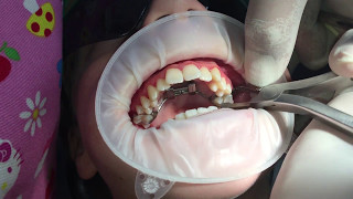 Removal of Rapid Palatal Expansion Appliance