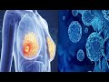 6 Early Warning Signs Of Cancer In Your Body You Should Not Know!