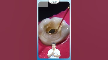 Quy Trình "Hồi Sinh" Chiếc Răng To Sâu Vỡ | Nha Khoa Minh Châu