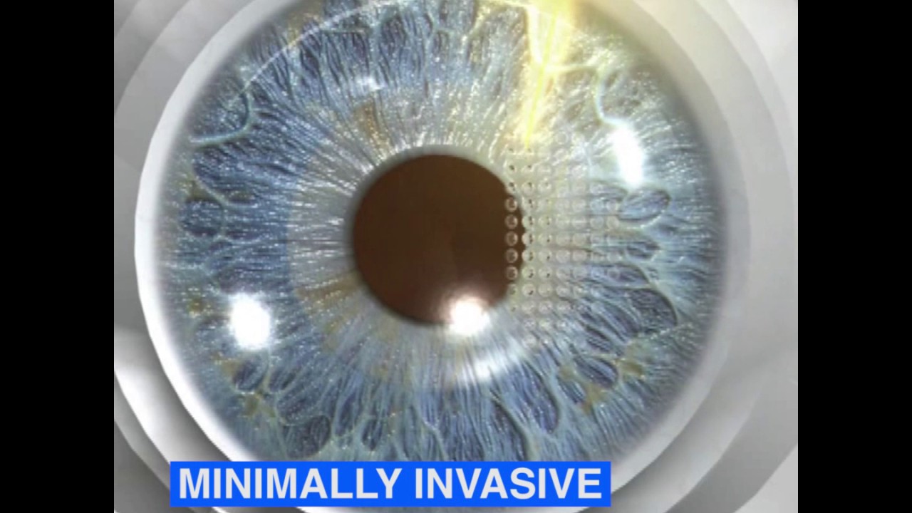 The KAMRA® Inlay Seminar