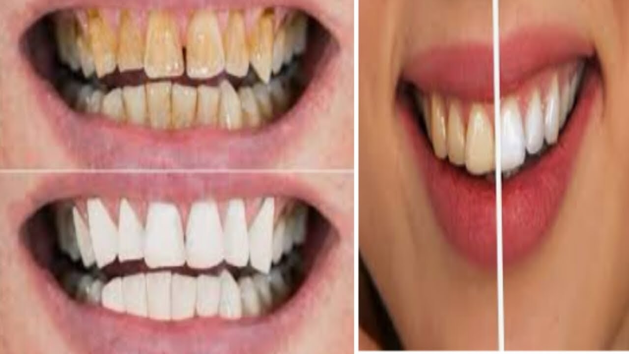 Teeth Whitening At Home In 3 Minutes How To Whiten Your Teeth
