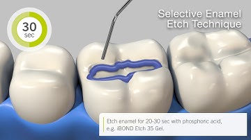 How to use iBOND Universal in total etch, selective enamel etch and self-etch technique (EN)
