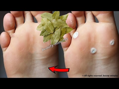 Видео: Plantar Warts -аас салах хамгийн сайн арга (Verrucas)