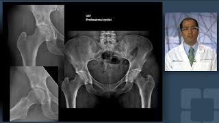 Hip Subchondroplasty To Manage Acetabular and Femoral Head Lesions in a Professional Cyclist