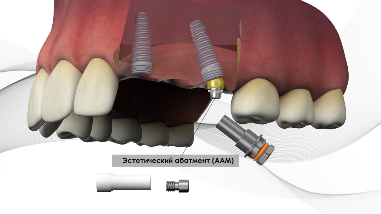 3d graphics and animation for Bio3 Implants