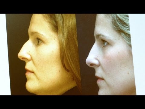Rinofast antes y despues de adelgazar Rinofast antes y despues de adelgazar