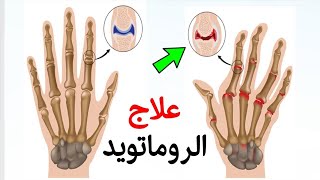 كيفيه علاج الروماتويد بدون ادويه تجربتي الشخصيه الخطوه الثالثه والاخيره