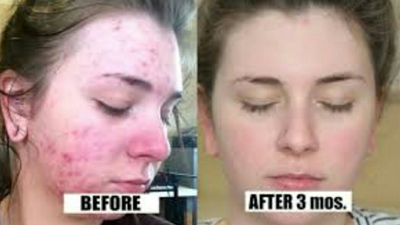 Sunny herbal Homeopathy face wash for acne pimple ll Baksons Homeopathy