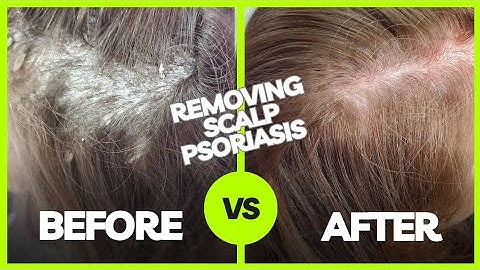 Removing Plaque Scalp Psoriasis | Using The Anti-Fungal Bundle myhappyscalp.com