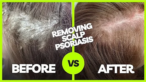 Removing Plaque Scalp Psoriasis | Using The Anti-Fungal Bundle myhappyscalp.com