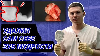 Удаление зуба мудрости, удалил себе зуб мудрости / (Выпуск 17)