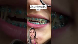 What Happens If You Don’t Wear Your Rubber Bands with Braces #orthodonticbraces #orthodontist