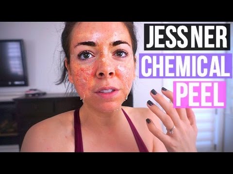 Vidéo: Avis et résultat du peeling Jessner