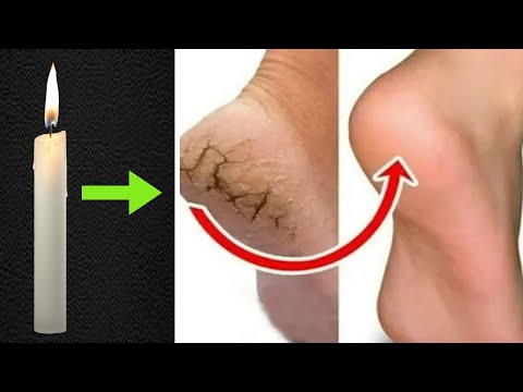 Video: Rissige Haut heilen (mit Bildern)