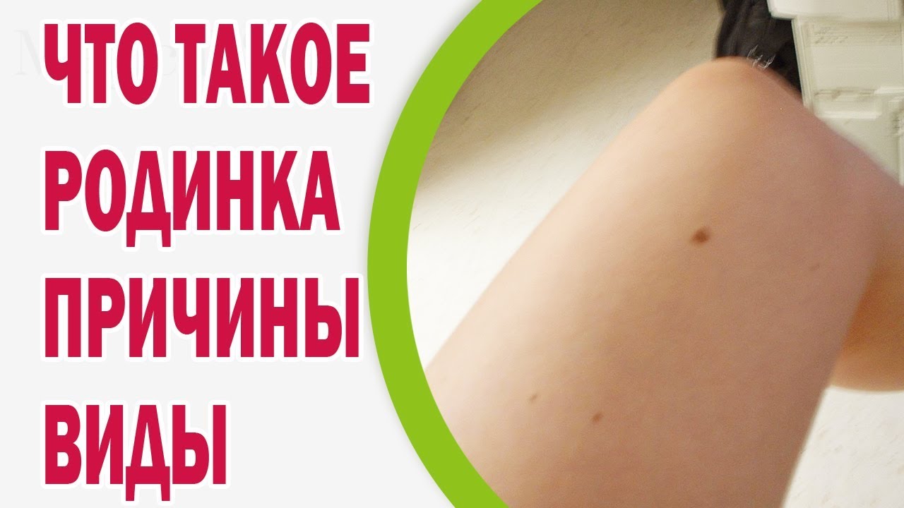 Что такое родинка: причины появления, виды