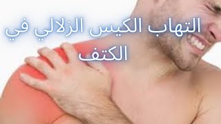 التهاب الكيس الزلالي|التهاب الكيس الزلالي في الكتف|علاج الكيس الزلالي|دكتور احمد حسن جمعه