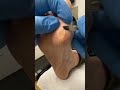 Watch as a skilled podiatrist works their magic to remove a thick, painful callus! 🦶✨ The