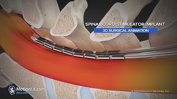 3D Surgery Animation of Spine Injury Portrays Spinal Cord Stimulator Implant