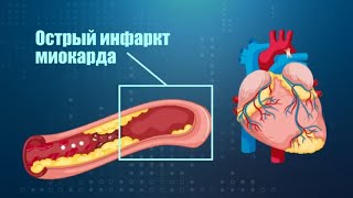Сердечная Стража: Знаки Острого Инфаркта и Пути Профилактики