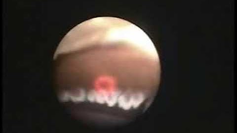 Michael Orr, MD ECP surgery video