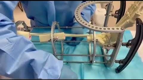 Circular External Frame Assembly for Tibial Osseous Restoration (Dr. Edgardo Rodriguez)