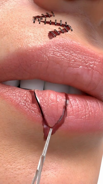 Z-plasty…💫 Animation by @plastic.touch. Unauthorized use or reposting of this animation is strict