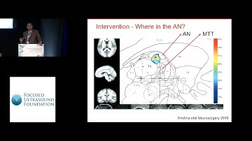 Vibhor Krishna - FUS thalamotomy for the prevention of secondary generalization in epilepsy (2018)