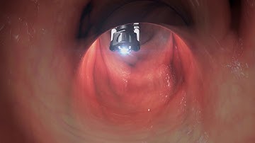 The Flex Robotic System is the first flexible robotic system commercialized for transanal procedures