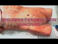 Пункція і катетеризація стегнової вени у дитини / Children Femoral vein puncture ENG subtitles