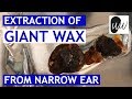 Extraction of GIANT WAX from Narrow Ear Canal Entrance - #393