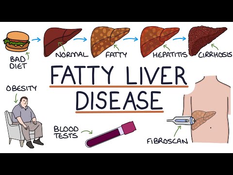 Understanding Non-Alcoholic Fatty Liver Disease