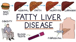 Understanding NonAlcoholic Fatty Liver Disease