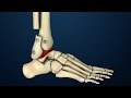 Arthrodesis | Transfibular Ankle Fusion Surgery | Nucleus Health