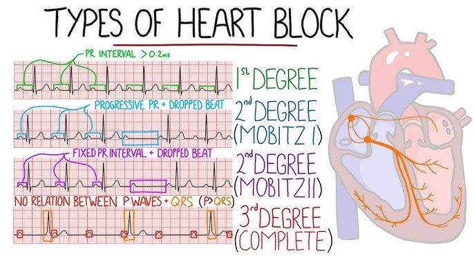 Atrioventricular Block, Heart Block