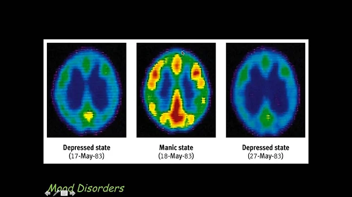 Mood Disorders, Dissociative Disorders, Schizophre...