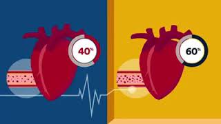 Ejection Fraction | Heart Health | Rose Heart & Vascular Center