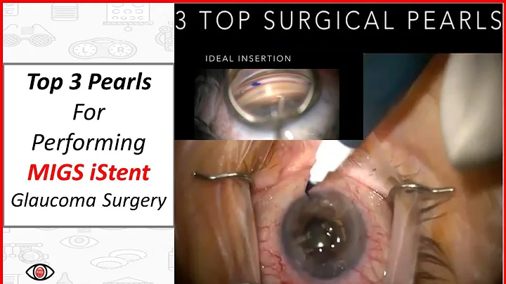 Top 3 Pearls for MIGS iStent (Trabecular Micro Byp...