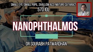 Nanophthalmos , Mature cataract, 57D IOL, Angle closure,Small pupil Dr Sourabh Patwardhan