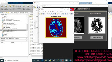 MRI and PET brain tumor image fusion tumor detection