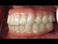 Prettau Zirconia with Zygomatic Dental Implant Example - Ramsey Amin DDS