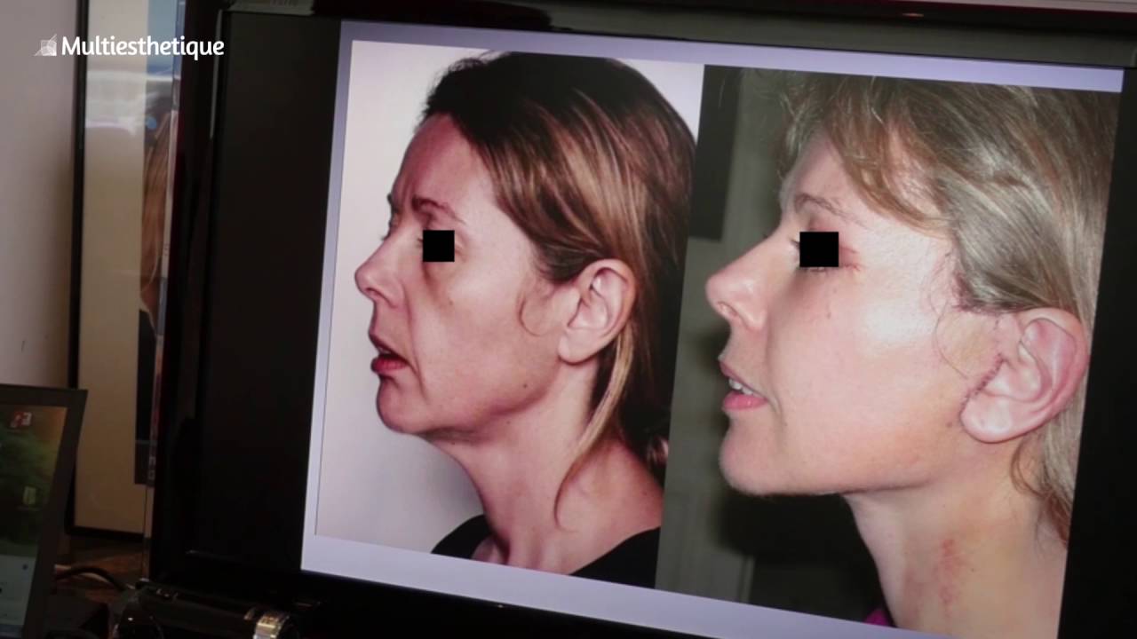 Lifting , soft-lift et mini-lift - Dr. Philippe Kestemont