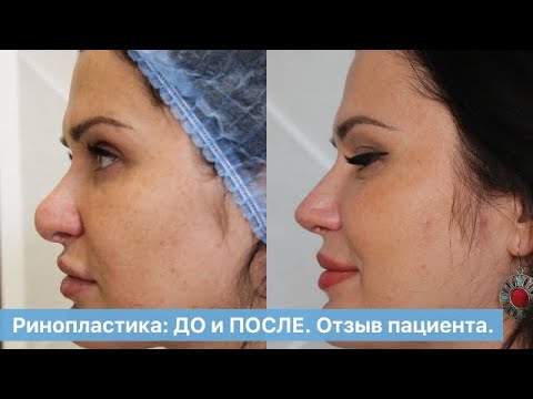 Ринопластика: ДО и ПОСЛЕ. Отзыв пациента. Как прошла операция в ОН КЛИНИК.