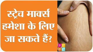 Why Do Stretch Marks Appear, Know From Doctors Tan Ki Baat Sehat Ep 229