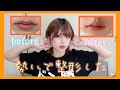 【術後レポ】エラボトとスマイルリップしてきたよーーーん