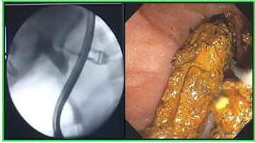 ERCP Stone Extraction At Square Hospital Ltd. Dhaka Bangladesh #BD_ENDOSCOPY