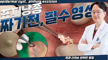 Epidermal Cyst Pinhole Excision 짜도짜도 계속나오고 냄새도 심한 표피낭종 제거 수술 흉터없는 핀홀법 