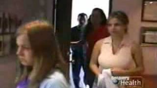15 years old gets breast reduction